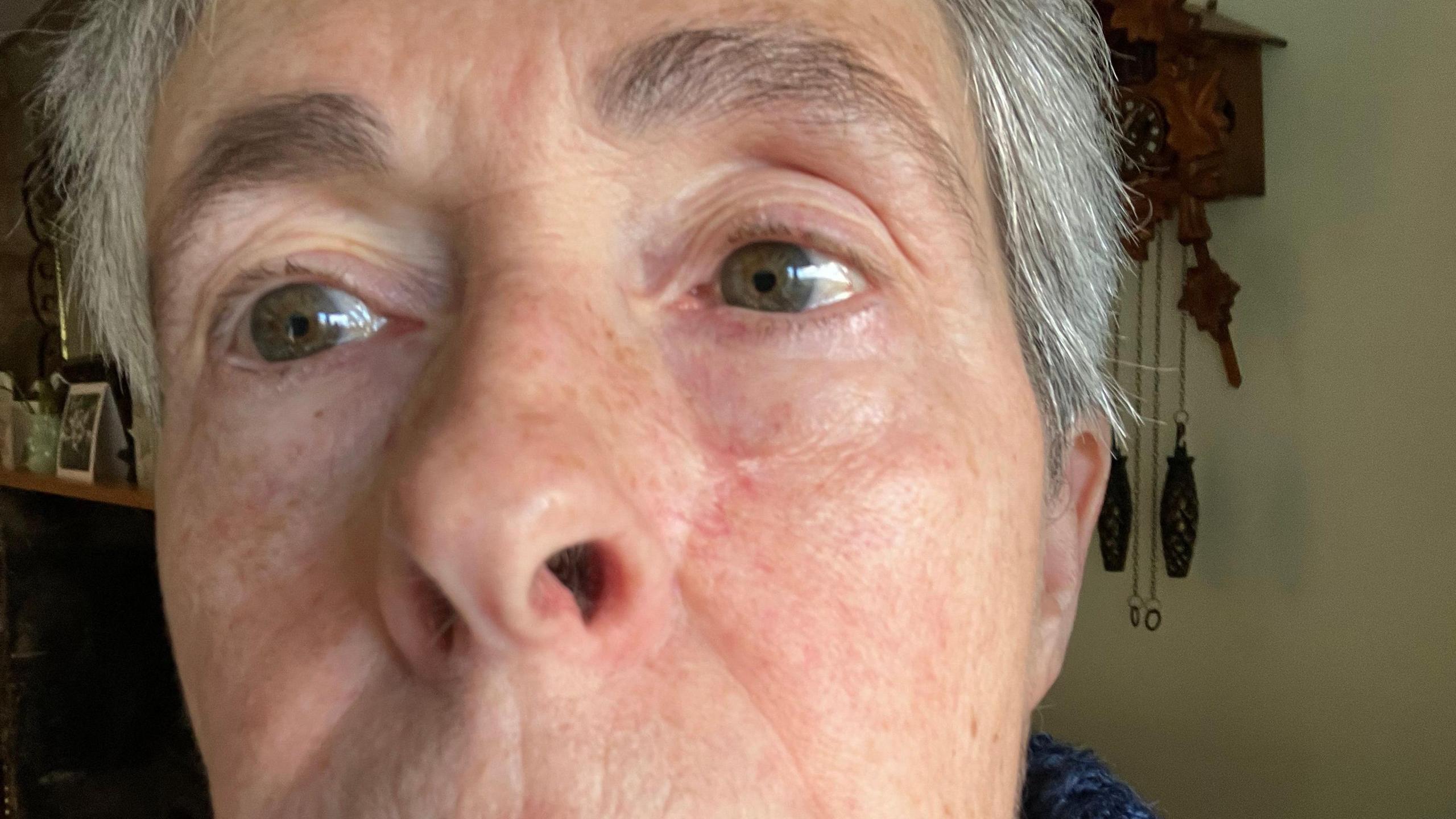 A close-up view of Lis Dales' face before the operation to remove her basal cell carcinoma. A small blemish is visible on her left cheek.