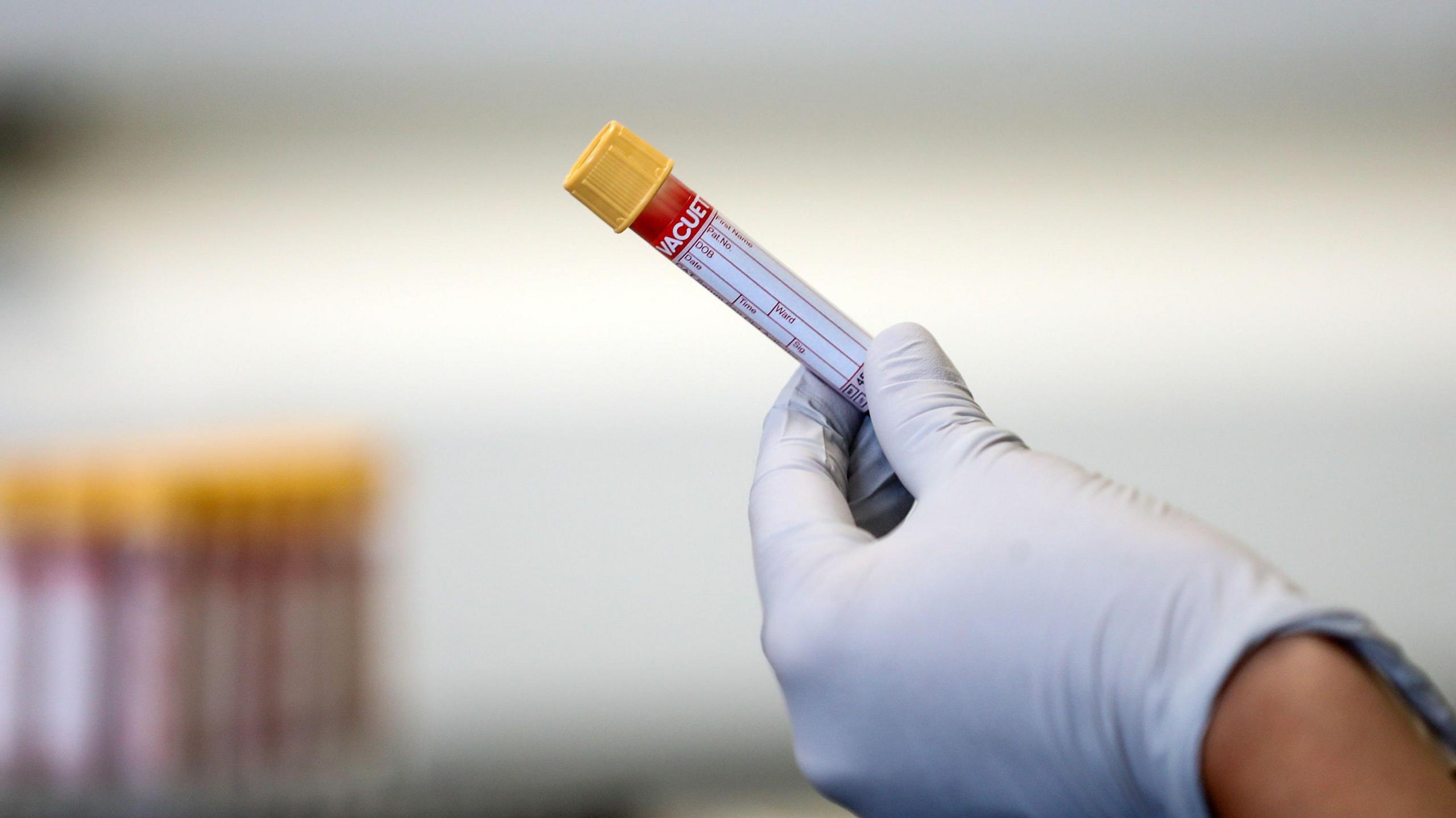 A gloved hand holding a vile of blood with a yellow cap and a label following a blood test with a tray of similar viles with yellow caps in the background on the left hand side and out of focus