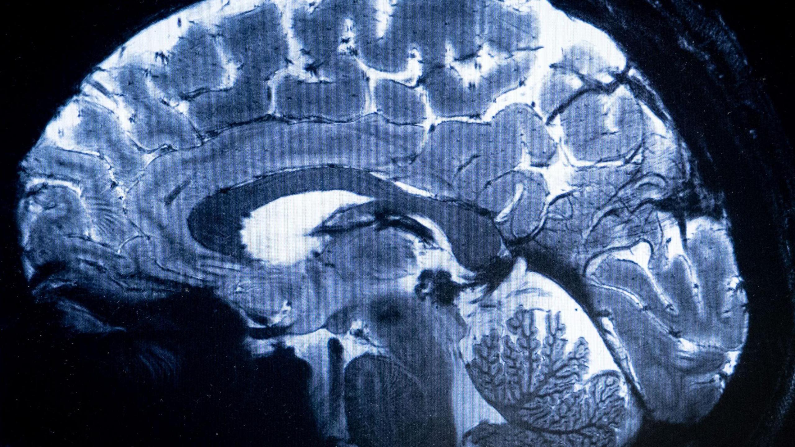 Scan of brain