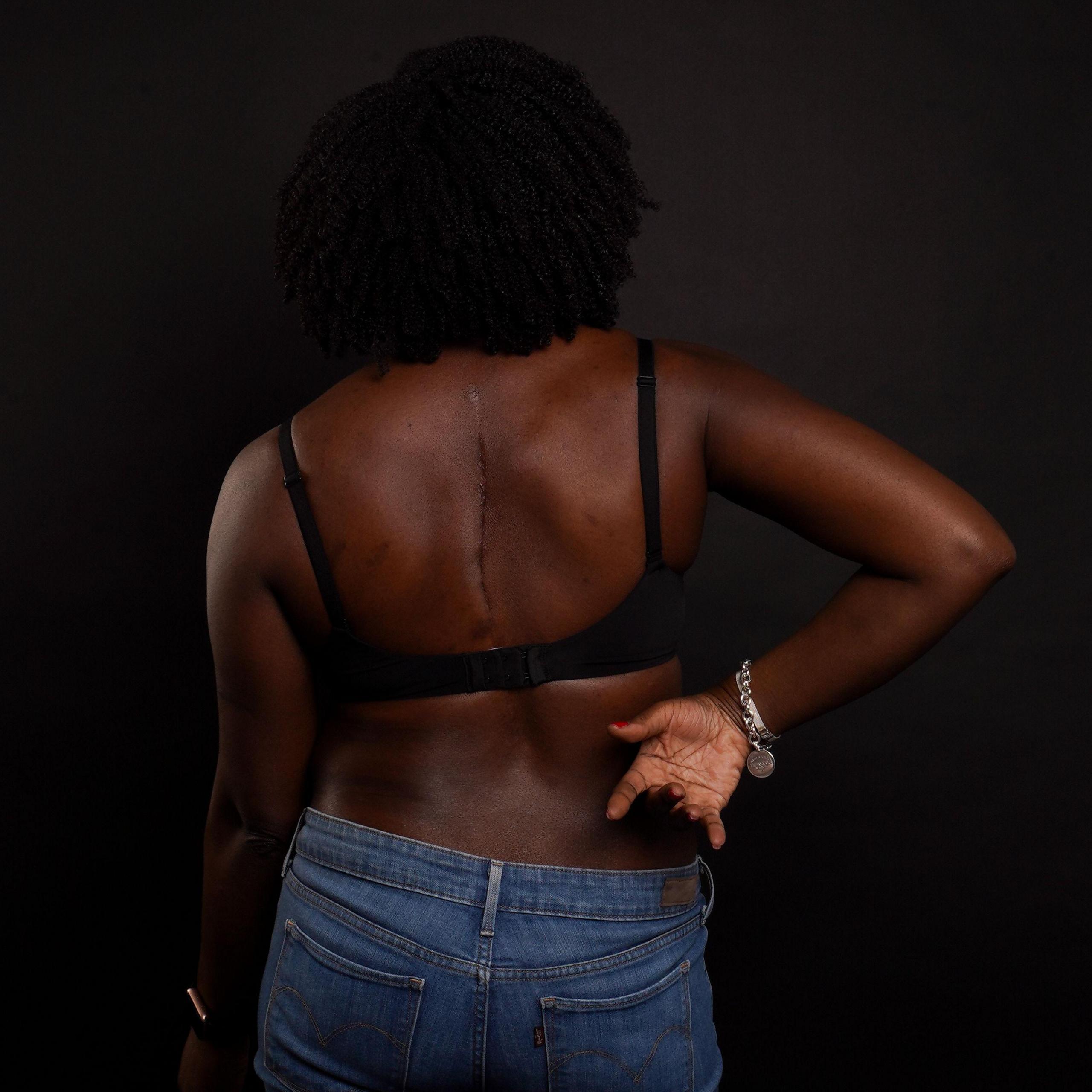 A woman stands against a dark grey studio backdrop. She is photographed from the back and her face cannot be seen. She is wearing jeans and a black bra. She has a scar running down the top half of her back.