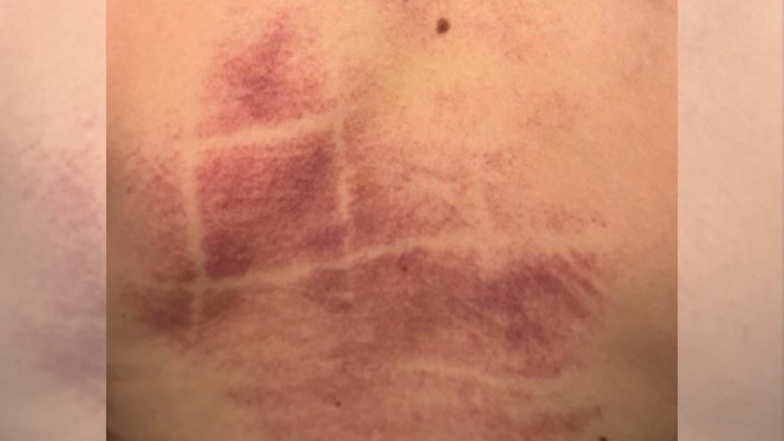 A close up of pink/purple bruising on a young boy's back