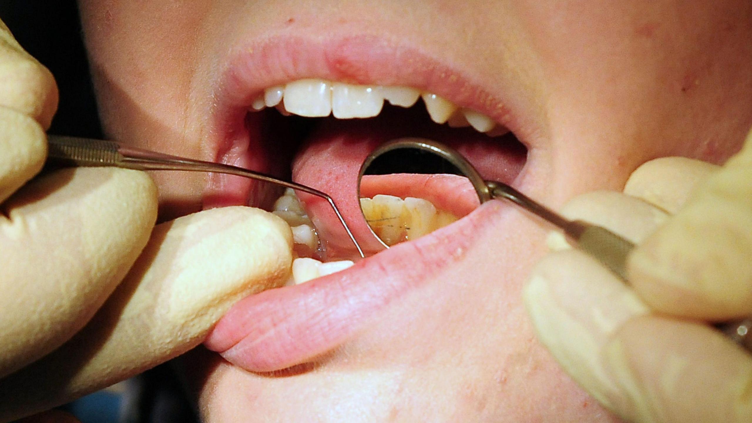 A patient being seen by a dentist. The image is a close-up of the patient's open mouth, while the dentist examines their teeth with equipment.