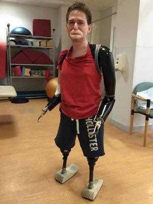 Alex wearing his four prosthetics