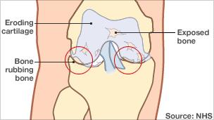 A diagram showing how osteoarthritis can affect the knee joints