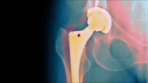 Hip replacement