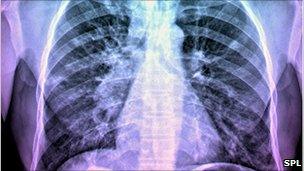 X-ray of the chest of a patient with TB