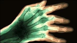 X-ray of a rheumatic hand