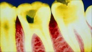 Coloured X-ray showing tooth decay