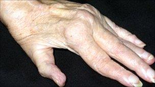 Rheumatoid arthritis