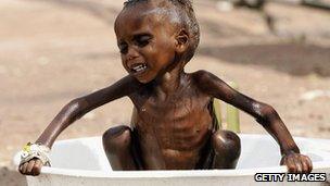 A malnourished child in Kenya