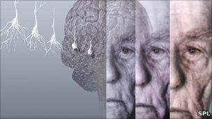 graphic of Alzheimer sufferer's brain