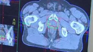 Scan of prostate