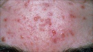 Acne on a patient's forehead