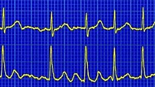 Atrial fibrillation on a heart trace called an ECG