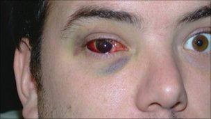 Clarence Harding's eye injury