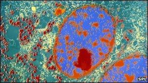 Neuroendocrine tumour