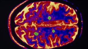 Brain of an MS patient