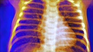 X-ray of a healthy chest