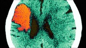 CT scan of a stroke