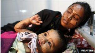 Acids attack victims in Bangladesh