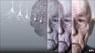 Conceptual computer artwork showing the brain of an elderly man affected by Alzheimer's disease