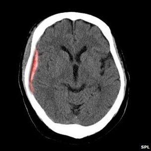 Subdural haemorrhage