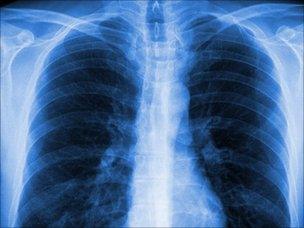 Lungs X-ray