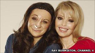 Chantelle Richardson with Katie Piper - who she is appearing with in a documentary called Katie: My Beautiful Friends