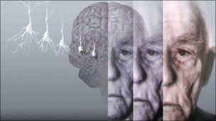 Alzheimer's graphic