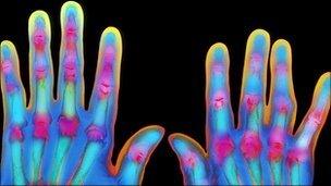 Picture of X-ray showing hands with rheumatoid arthritis