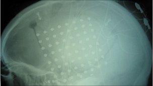 X-ray of electrode array