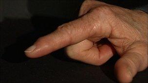 Arthritic finger