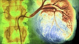 X-ray showing kidney cancer