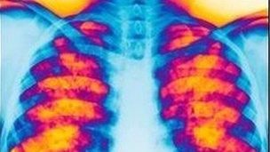 Cystic fibrosis x-ray