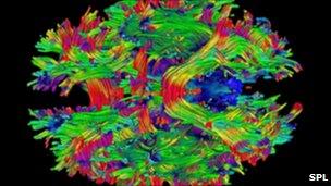 DTI scan of a brain tumour