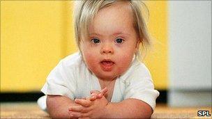 Child with Down's syndrome