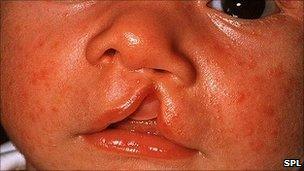 Cleft lip