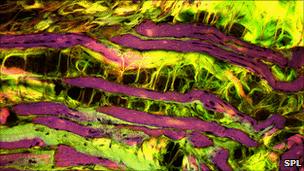 Muscle tissue turning to fat