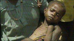 A malnourished boy in Somalia in 1992