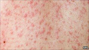 Measles rash