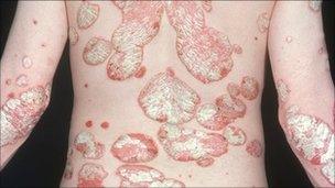 Psoriasis on back of patient