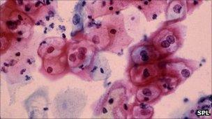 HPV on a smear