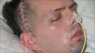 Derry civil servant Paul McCauley after he was beaten up in a sectarian attack in July 2006