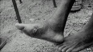 Guinea worm