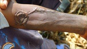 A child with a scarred arm