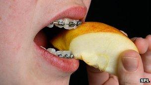 Eating with braces (Credit: SPL)