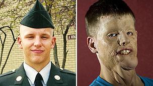 US Army private Mitch Hunter before the accident and how he looked before the face transplant