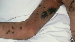 Kaposi's sarcoma on arm of Aids patient