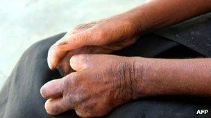 Hands of a Madagascan leprosy patient