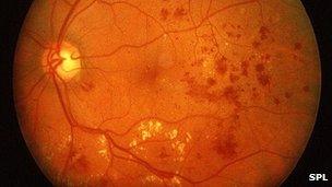 Diabetic macular oedema